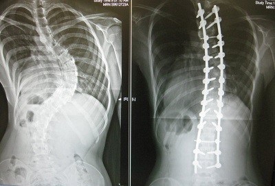 S alakú scoliosis - okoz mértékben kezelések