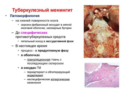 Tuberkulotikus meningitis-, a tünetek és a kezelés, a diagnózis, a jelentett (TB) Gümőkóros agyhártyagyulladás, tünetei és kezelése, diagnózis, amint arról