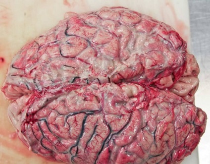 Tuberkulotikus meningitis-, a tünetek és a kezelés, a diagnózis, a jelentett (TB) Gümőkóros agyhártyagyulladás, tünetei és kezelése, diagnózis, amint arról