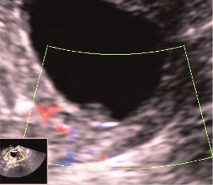 Ultrahang diagnosztika az endometrium polipok és méhnyak - Ryabov és