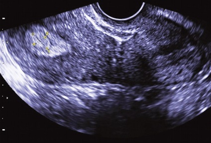 Ultrahang diagnosztika az endometrium polipok és méhnyak - Ryabov és