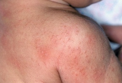 A gyermek bőrkiütéseket a bőrén, hasonló szúnyogcsípés