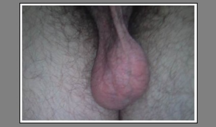 Varicocele fotó-cikket a betegség (a here varicocele fotó) Varicocele fotó-cikket a betegség