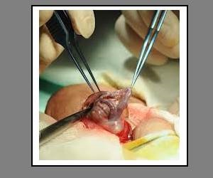 Varicocele fotó-cikket a betegség (úgy néz ki, mint egy varicocele fotó) Varicocele fotó-cikket a betegség