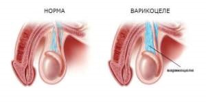 Varicocele fotó-cikket a betegség (betegség varicocele fotó) Varicocele fotó-cikket a betegség