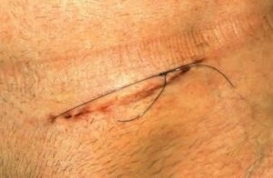 Testicularis varicocele a férfiak, mi az, és úgy néz ki, mint a betegséget a fotó, a történelem, a betegség, valamint a (varicocele, hogy az) Testicularis varicocele a férfiak, mi az, és úgy néz ki, mint a betegséget a fotó, a történelem, a betegség, valamint a