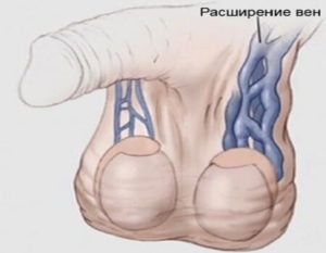 Testicularis varicocele a férfiak, mi az, és úgy néz ki, mint a betegséget a fotó, a történelem, a betegség, valamint a (varicocele a férfiaknál) Testicularis varicocele a férfiak, mi az, és úgy néz ki, mint a betegséget a fotó, a történelem, a betegség, valamint a