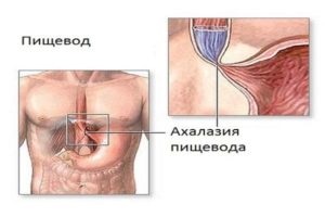 A nyelőcső gyulladása tünetek és kezelés