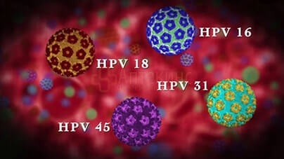 HPV 16 nőkben - kezelés, a tünetek és diagnózis