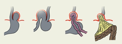 Axiális hiatus hernia, a kezelés mértékét (fok) Axial hiatus hernia, kezelés mértékét