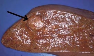 A mellékvesevelő-daganat (phaeochromocytoma) tünetei