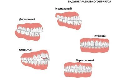 Malocclusion - milyen mértékben, megelőzés, típusai (okozhat) Malocclusion - milyen mértékben, a megelőzési, típusai