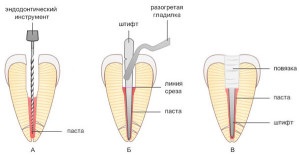 Cipő gyökérkezelés gyökértömés módszerek endodontális kezelés (tisztítás) Cipő gyökérkezelés gyökértömés módszerek endodontikus