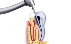 Cipő gyökérkezelés gyökértömés módszerek endodontikus