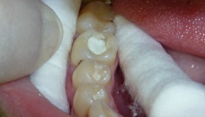 Cipő gyökérkezelés gyökértömés módszerek endodontális kezelés (fog) Cipő gyökérkezelés gyökértömés módszerek endodontikus