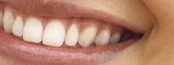 Melyik a jobb - a kezelt fogak minőségileg csatornák vagy implantátum helyett távoli