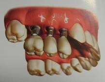 Melyik a jobb - a kezelt fogak minőségileg csatornák vagy implantátum helyett távoli