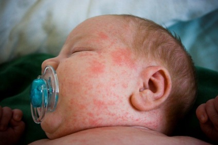 Mi malária - elzáródása a verejtékmirigyek csecsemők - Betegségek