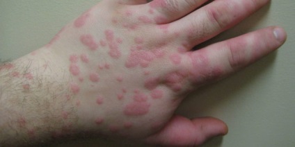 Diagnózis urticaria, immuninfo (diagnosztika) Diagnózis urticaria, immuninfo