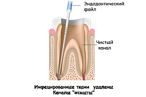 Endodontic terápia fogak gyökércsatorna