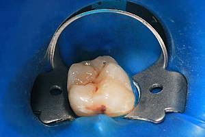 Endodontic terápia fogak gyökércsatorna