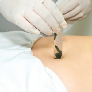 Hirudotherapy a visszér - véleménye, ellenjavallatok és mellékhatások (girudoterapija) Hirudotherapy visszeres - véleménye, ellenjavallatok és mellékhatások