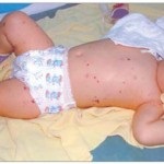 Meningococcus betegség gyermekeknél - Medical Journal