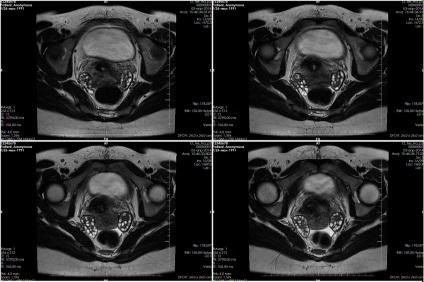 MRI kontraszt kismedencei - előállítására, adagolás, ellenjavallatok és előnyök