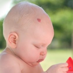 Tűnő pigmentált foltok okainak gyermekek kezelésére