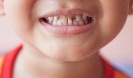 Miért van a gyerek fekete fogak lehetséges okok, hogyan lehet megoldani a problémát