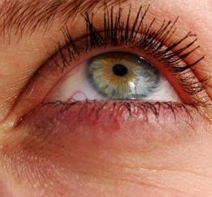 Bőrpír a szem körül okok és a kezelés