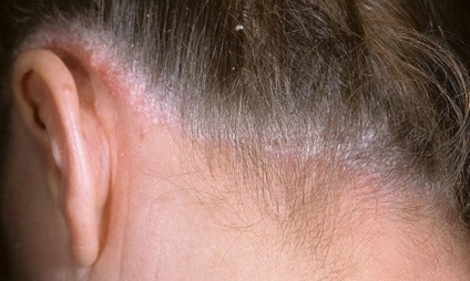 hogyan lehet gyógyítani a fejbőr pikkelysömörét örökre otthon