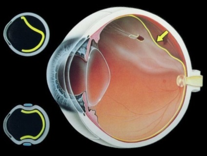 Koraszülött-retinopátia színpad és minőségű, okai, tünetei, diagnózis és kezelés,
