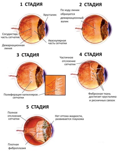 Koraszülött-retinopátia színpad és minőségű, okai, tünetei, diagnózis és kezelés,
