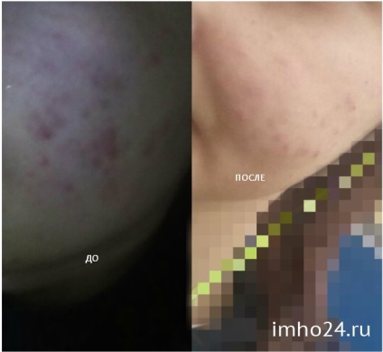 Streptotsida 5% kenőcs válaszok (streptotsida) Streptotsida 5% kenőcs vélemény