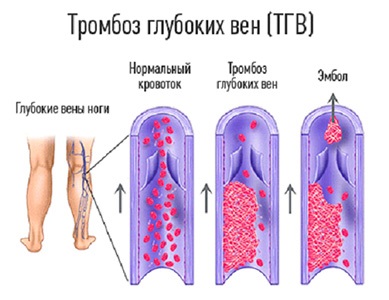 Mélyvénás trombózis