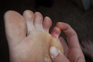 zúzódás a lábujj ízületén ízületek fájdalom után a vízszintes sávon