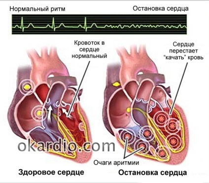 Hirtelen szívhalál (SCD) okoz, a tünetek, elsősegély és előrejelzés