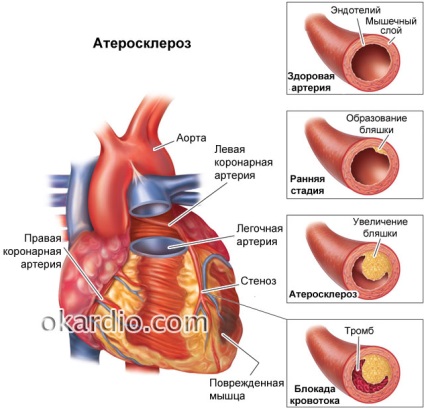 Hirtelen szívhalál (SCD) okoz, a tünetek, elsősegély és előrejelzés