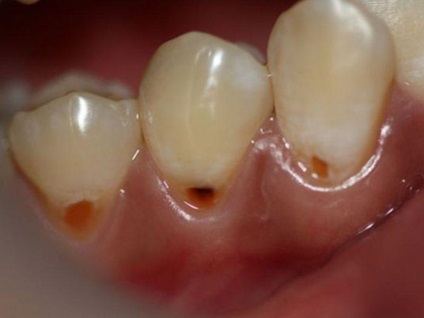 Fogbetegségek - osztályozás és betegségek kezelésében a fogak