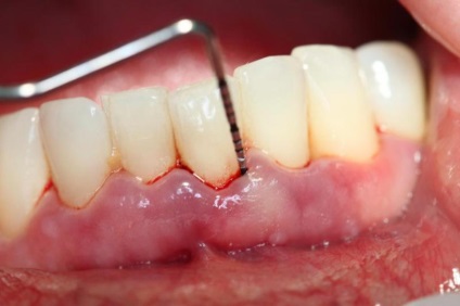 Fogbetegségek - osztályozás és betegségek kezelésében a fogak