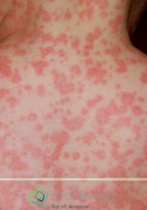 Allergiás típusú foltoknál és a kezelés (ek) a Allergiás típusú foltoknál és a kezelés