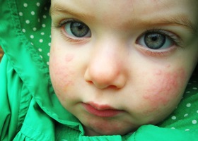 Allergia hideg gyermek - Tünetek és kezelés
