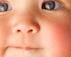 Allergia ceftriaxon és Augmentin a gyermek, gyermekgyógyászat