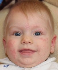 Allergia almalé csecsemőknél - gyermek allergia