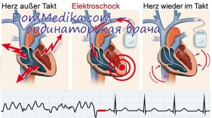 Aneurizma szívinfarktus után - a szív-