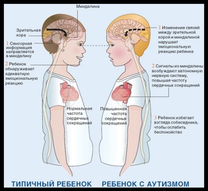 Atípusos autizmus (autizmus) atípusos autizmus