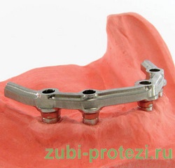 Beam protézisek (Trimmer protézielemével) gerenda protézisek