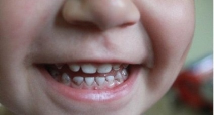 Fekete plakk a fogak gyermekeknél okoz (6 fénykép) miért megfeketedik (gyermek) Fekete plakk a fogak gyermekeknél okoz (6 fotó) miért megfeketedik