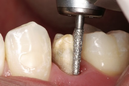 Mik a jellemzői fém korona gyártása és telepítése (metalloplastmassa fogak) Mik a jellemzői fém korona gyártása és telepítése